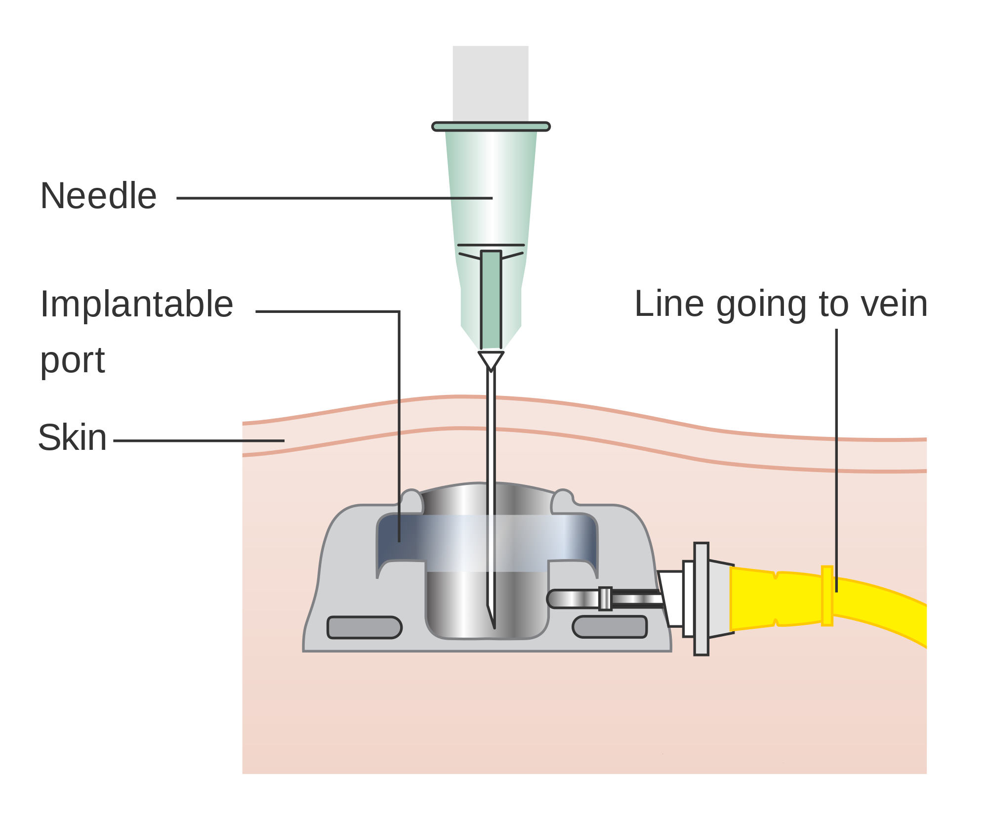 Implantables